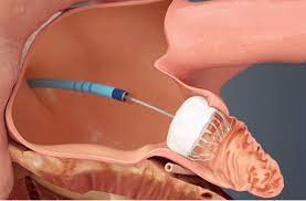 Watchman Implant: Protecting Your Heart Health