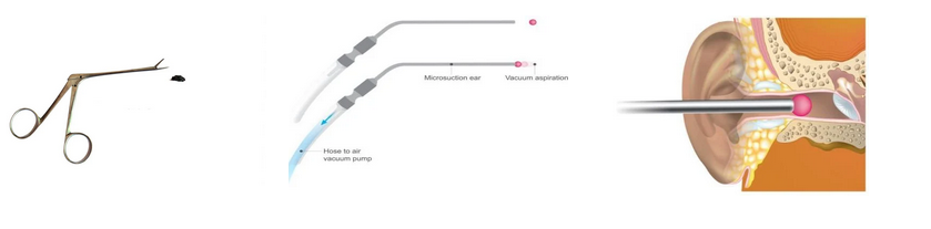 Effective Ear wax removal Techniques in Singapore: Restoring Auditory Clarity