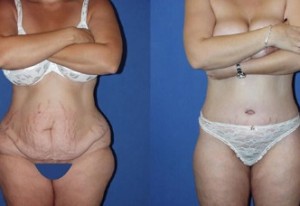 Make Sure You’re Ready for Abdominoplasty Surgery in Miami